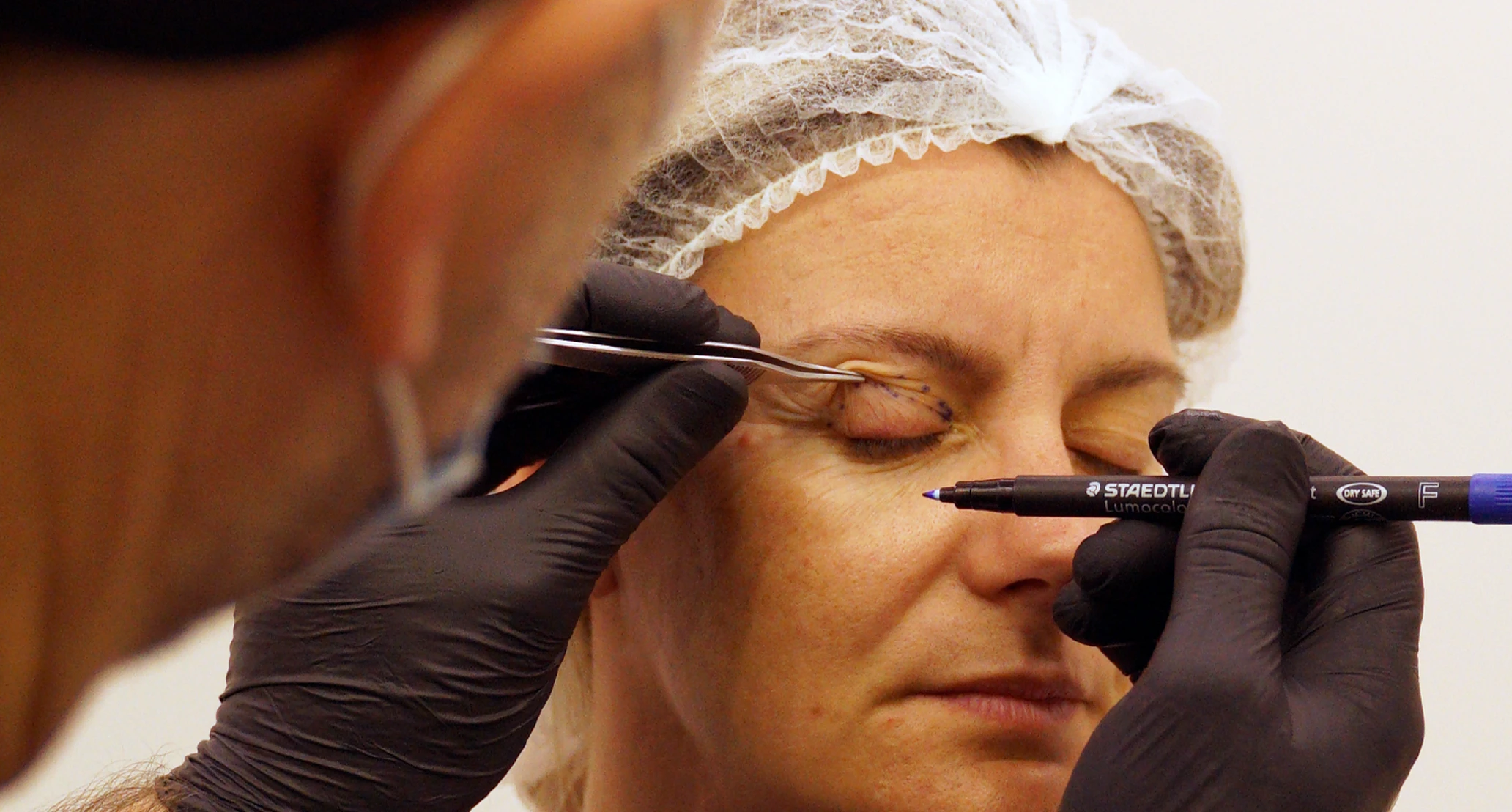 EIMEC cirugia-blefaroplastia--curso practico-barcelona-estetica